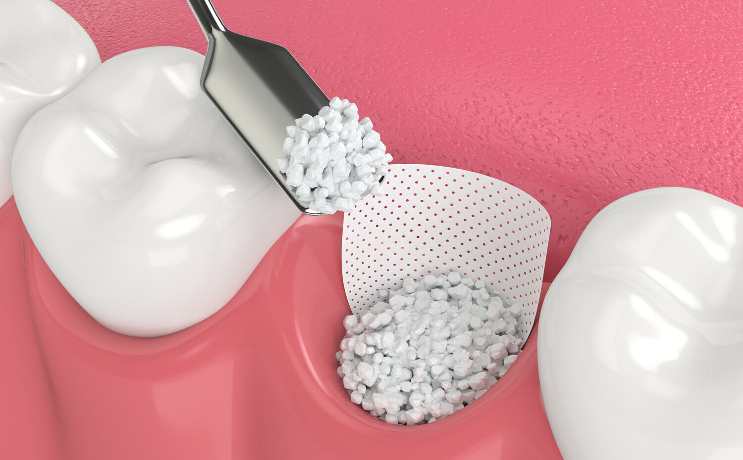 Enjoying candy carefully with veneers, bonding, or an implant crown